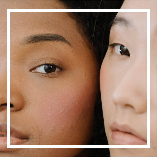 Everything You Need To Know About Why Winter Acne Is So Stubborn