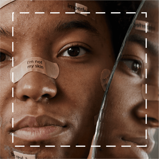 How to Take Care of Your Mental Health When Struggling With Acne