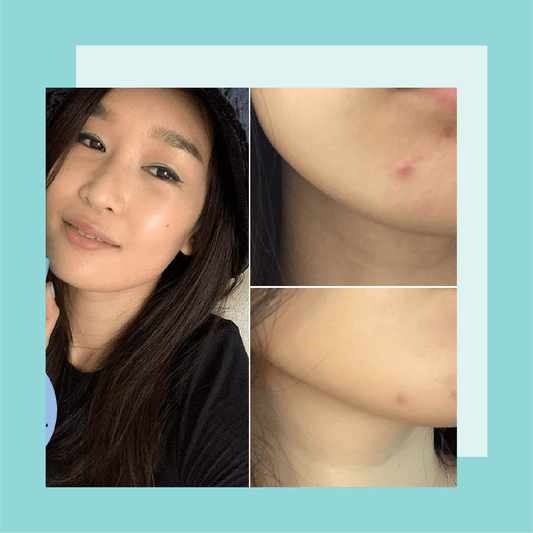 Glow Deeper™ Series: The Two Products That Finally Helped Me Get Rid of My Persistent Hormonal Acne