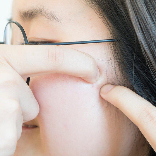 How to Prevent Scarring After You’ve Popped a Pimple