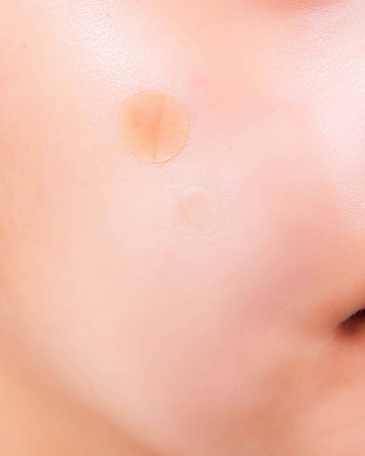 A-Clear Soothing Clear Spot Patch